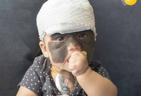 (تصاویر) نوزادی که با ماسک بتمن متولد شده!